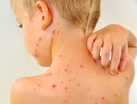 Parut Chicken Pox Hilang Dengan Cepat
