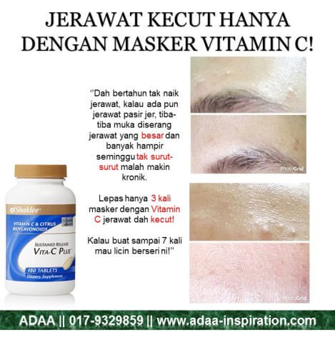 Testimonial: Jerawat Kecut, Parut Makin Pudar