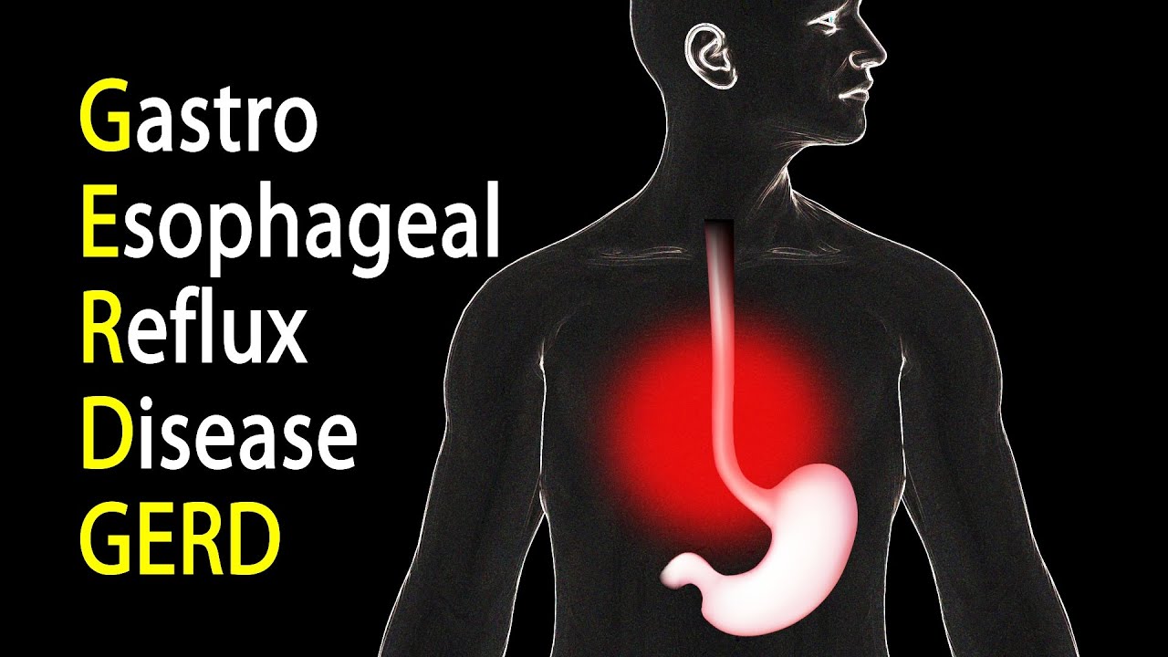 Gastrik Gerd dan Anxiety