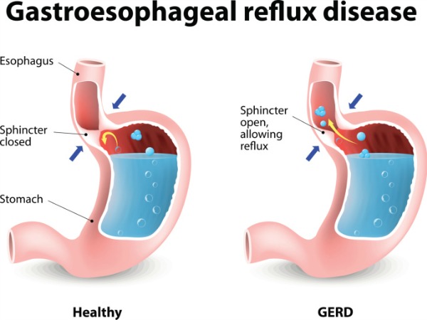 Gastrik Gerd dan Anxiety