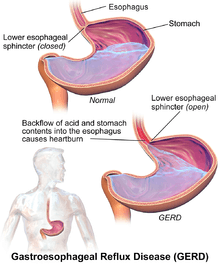 Gastrik Gerd dan Anxiety