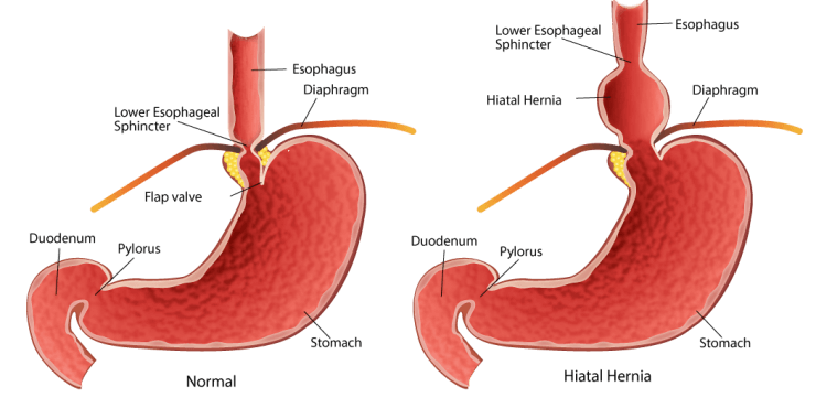 Gastrik Gerd dan Anxiety
