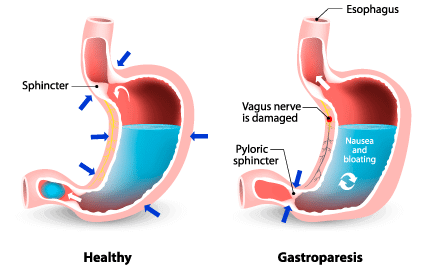 Gastrik Gerd dan Anxiety