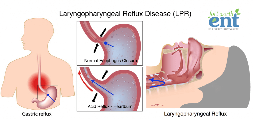 Gastrik Gerd dan Anxiety