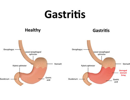 Gastrik